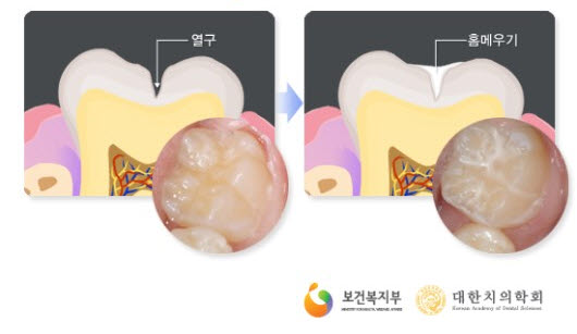 대부보건지소, 치아홈메우기 ‘무료’ 실시